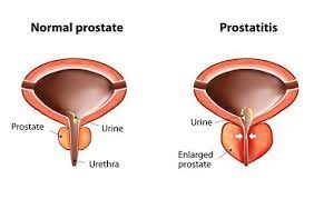 chron Prostatits3